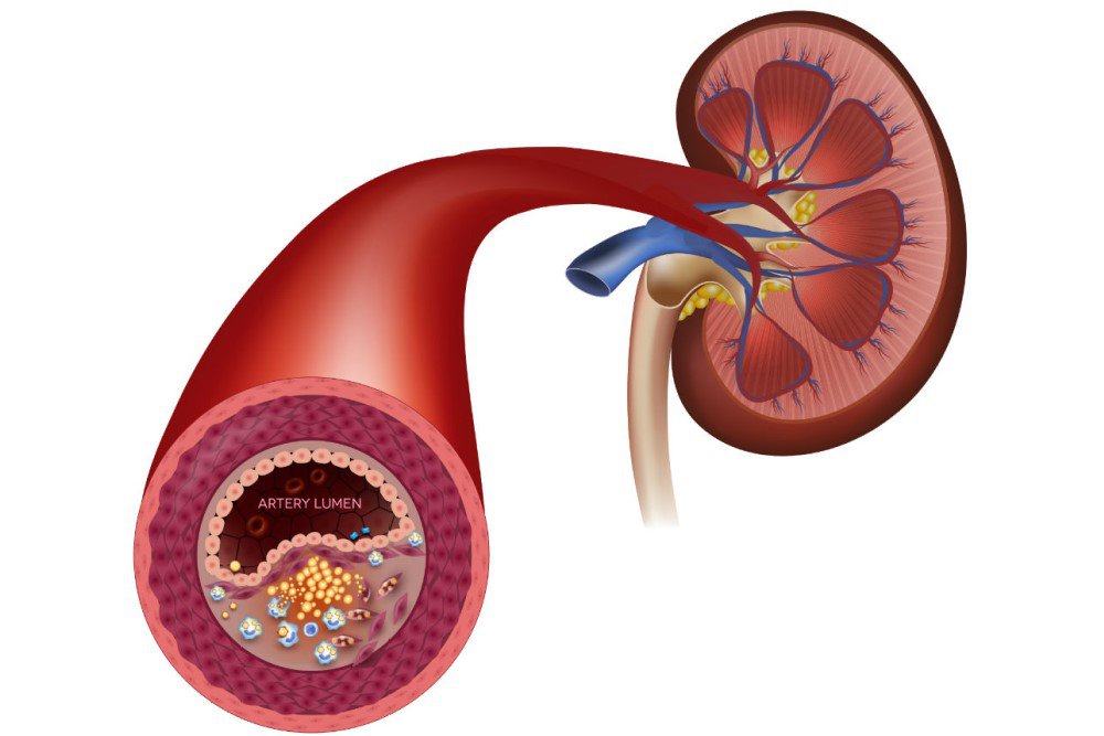 Evaluation and Management of HTN