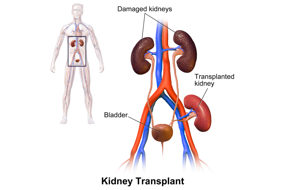 Kidney Transplant - Post Op Treatment