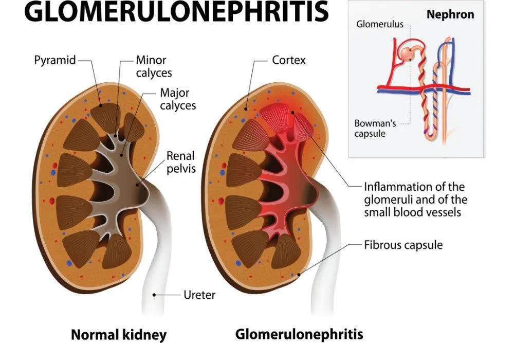 Glomerulonephritis