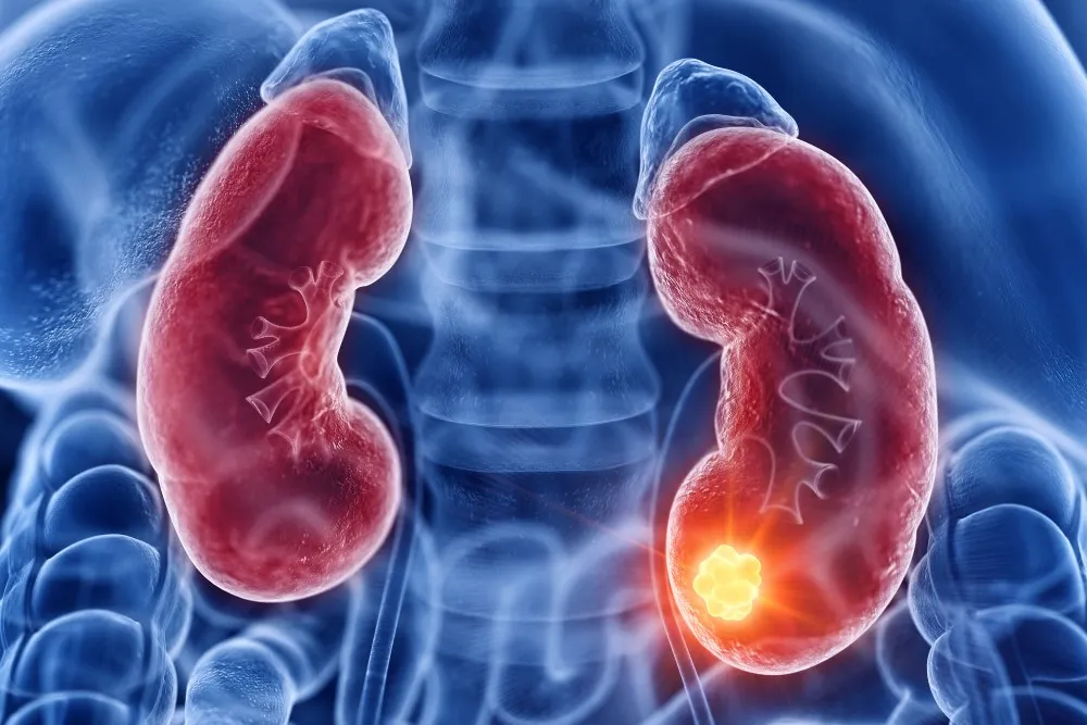 Kidney Disease Treatment