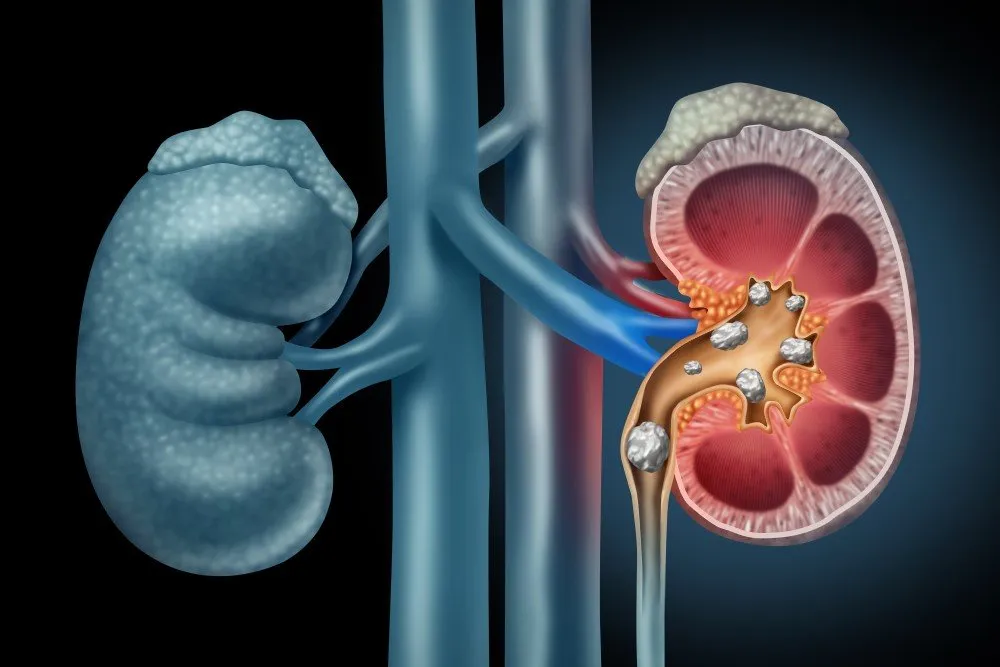 Kidney Stones Treatment